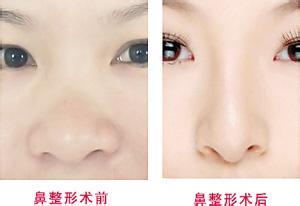 鼻翼縮小手術(shù)費(fèi)用是多少