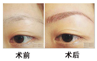 繡眉費用多少錢