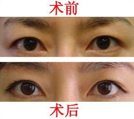 提眉術(shù)術(shù)后護(hù)理
