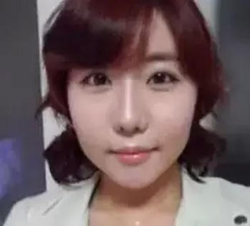 全臉脂肪填充 打造韓系美女