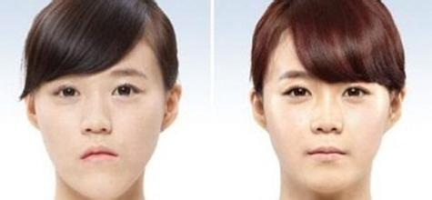 地包天矯正有哪些手術方法
