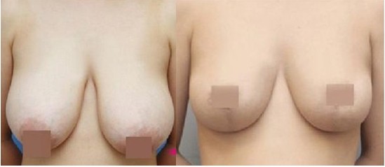 巨乳縮小術對比照