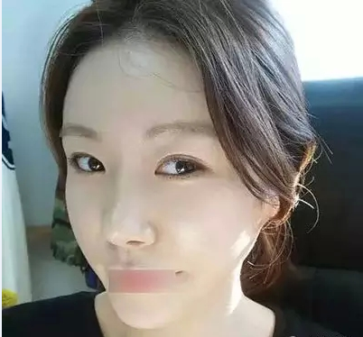 雙眼皮+隆鼻+全臉脂肪移植 想要美一切皆有可能