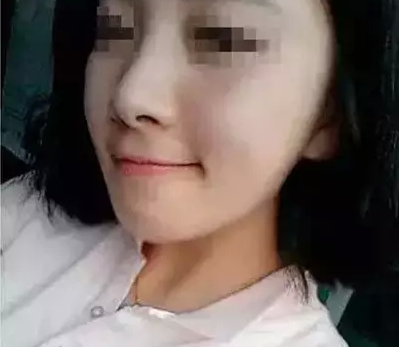 假體隆鼻 五官越來越好看了