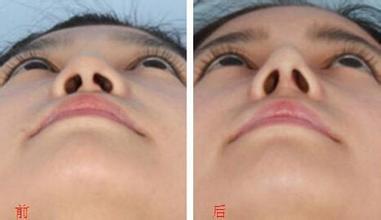 鼻翼縮小效果怎么樣