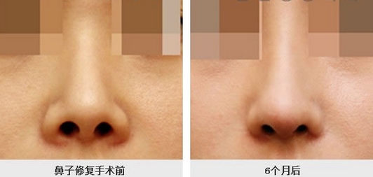 歪鼻矯正術(shù)康復(fù)與護(hù)理有哪些