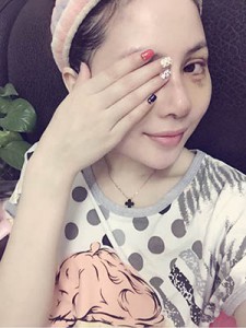 隆鼻+全切雙眼皮 美到無(wú)法呼吸 - 珍美網(wǎng)