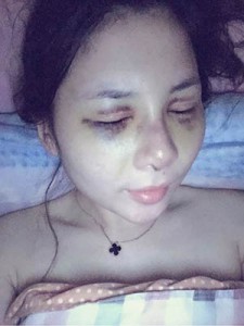 隆鼻+全切雙眼皮 美到無(wú)法呼吸 - 珍美網(wǎng)