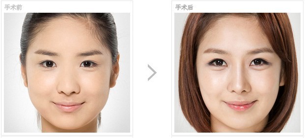 臥蠶整形有什么優(yōu)勢