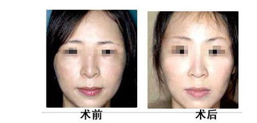 提眉術(shù)術(shù)后效果如何