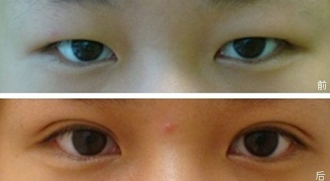 上眼皮下垂提升術(shù)幾種方法