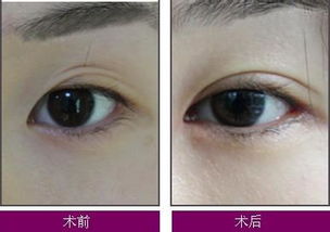 雙眼皮修復(fù)有幾種分類