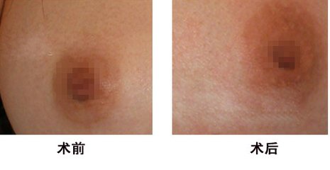 乳頭內(nèi)陷矯正術(shù)有什么方法