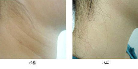 激光除皺術(shù)后如何護(hù)理