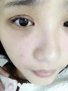 雙眼皮手術(shù) 讓自己更加甜美可愛(ài) - 珍美網(wǎng)