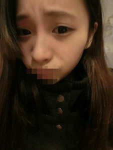 雙眼皮手術(shù) 讓自己更加甜美可愛