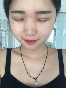 全切雙眼皮 開啟心靈之窗