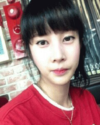 自體脂肪豐額頭+顴骨整形 讓我更精致做女人