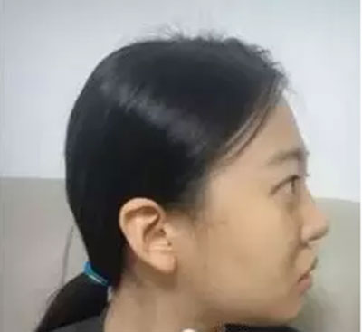 自體脂肪面部填充 精致做個(gè)氣質(zhì)美女 - 珍美網(wǎng)