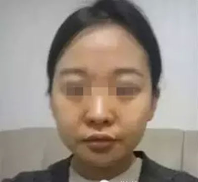 自體脂肪面部填充 精致做個(gè)氣質(zhì)美女 - 珍美網(wǎng)
