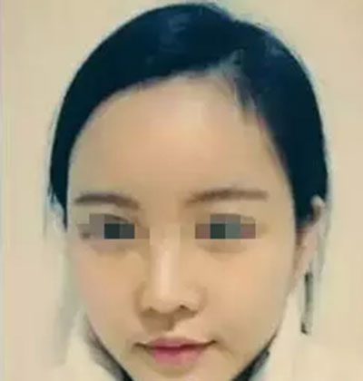 自體脂肪面部填充 精致做個(gè)氣質(zhì)美女 - 珍美網(wǎng)