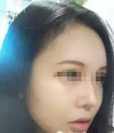 自體脂肪面部填充 精致做個(gè)氣質(zhì)美女