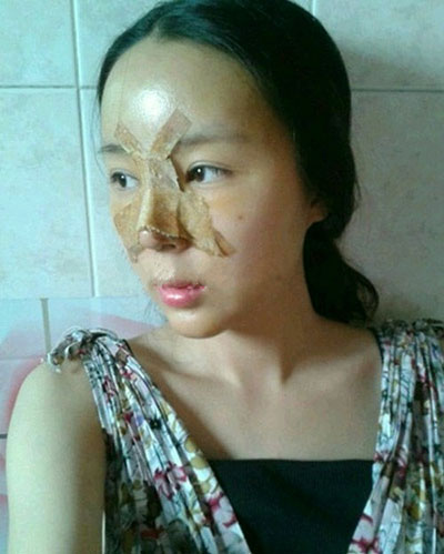 埋線法雙眼皮+硅膠隆鼻 把自己變得完美 - 珍美網