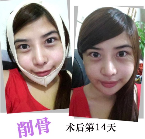 削骨整形 逆襲成回頭率百分百 - 珍美網(wǎng)