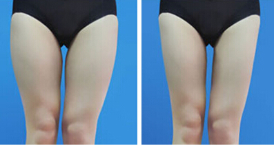 大腿吸脂費(fèi)用是多少