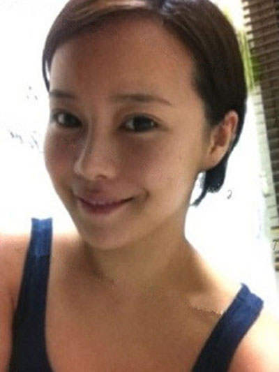 面部脂肪填充術(shù) 讓自己變得更加清新可愛美麗