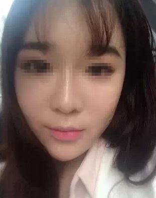 【玻尿酸填充淚溝+法令紋+豐蘋果肌】 變成靚麗的美眉 - 珍美網(wǎng)