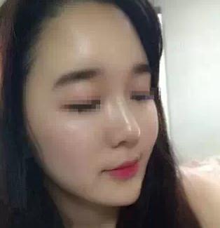 【玻尿酸填充淚溝+法令紋+豐蘋果肌】 變成靚麗的美眉 - 珍美網(wǎng)