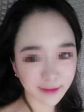 【玻尿酸填充淚溝+法令紋+豐蘋果肌】 變成靚麗的美眉 - 珍美網(wǎng)