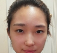 棱角下巴矯正+前顴骨磨骨 實現(xiàn)完美的臉蛋 - 珍美網(wǎng)