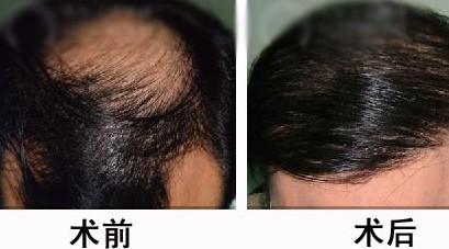 武漢碧蓮盛整形醫(yī)院頭發(fā)種植的價格是多少呢 - 珍美網(wǎng)