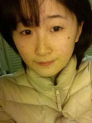激光祛斑 還原成小清新姑娘 - 珍美網(wǎng)