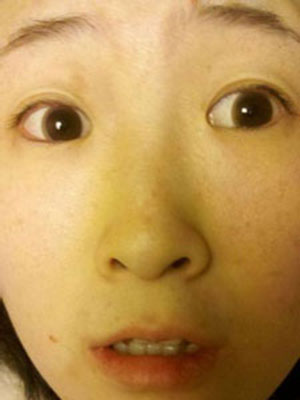 激光祛斑 還原成小清新姑娘
