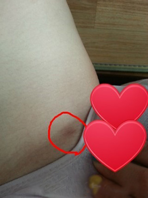 【大腿+腰部+ 屁股的吸脂整形】 性感苗條完美女人 - 珍美網(wǎng)