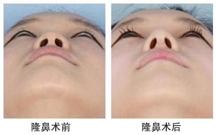 大連新華整形醫(yī)院膨體隆鼻手術(shù)價(jià)格是多少 - 珍美網(wǎng)