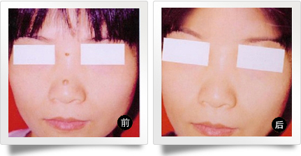 李碧容激光去痣價(jià)格是多少 - 珍美網(wǎng)