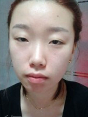 面部整形 給自己一個靚麗的青春 - 珍美網(wǎng)