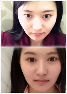 眼部整形 讓五官更加清晰美麗