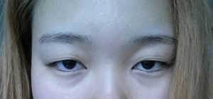 雙眼皮手術(shù) 魅力無(wú)限大 - 珍美網(wǎng)