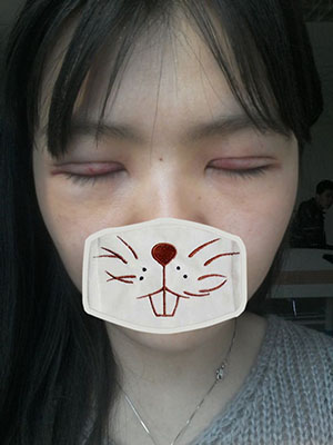 雙眼皮手術(shù) 實(shí)現(xiàn)閃亮的大眼睛 - 珍美網(wǎng)