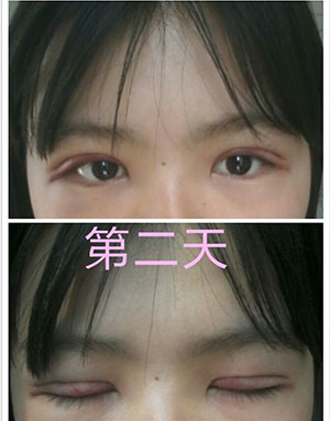 雙眼皮手術(shù) 實(shí)現(xiàn)閃亮的大眼睛 - 珍美網(wǎng)