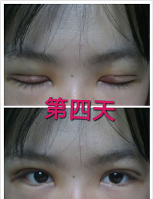 雙眼皮手術(shù) 實(shí)現(xiàn)閃亮的大眼睛 - 珍美網(wǎng)