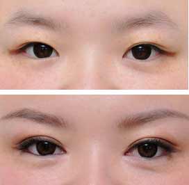 無錫春天整形醫(yī)院開眼角手術(shù)費(fèi)用是多少 - 珍美網(wǎng)