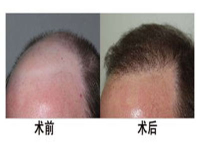 郭曄頭發(fā)種植價格多少錢 - 珍美網(wǎng)