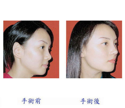 王軍隆鼻價格是多少 - 珍美網(wǎng)