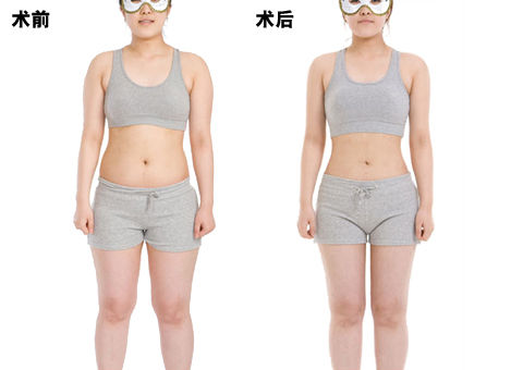 廈門(mén)思明華美整形醫(yī)院吸脂手術(shù)價(jià)格是多少 - 珍美網(wǎng)